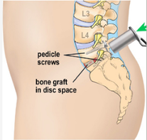 Minimally Invasive Spine Surgery (MISS) 