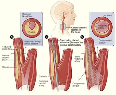 Carotid stent insertion for carotid stenosis