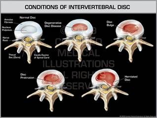 Condition of Intervertebral Disc